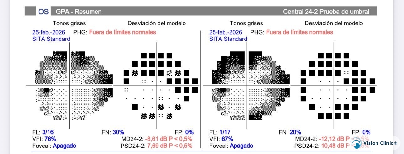 Example of a visual field study
