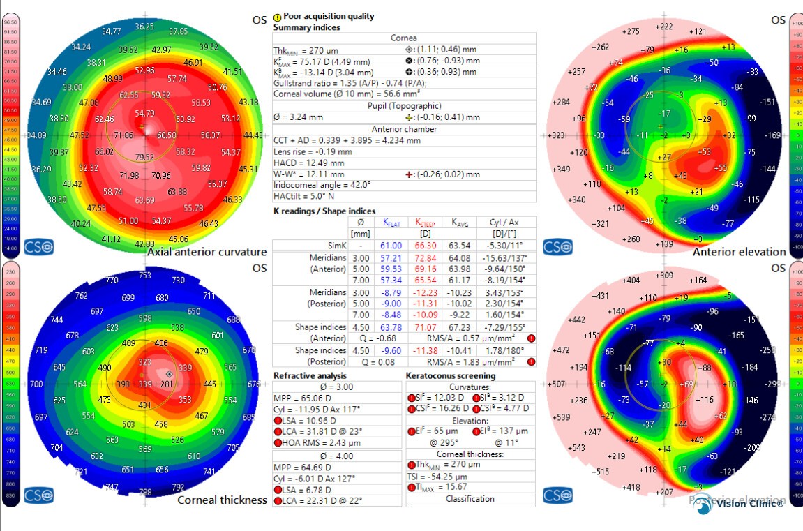 Ejemplo de estudio de tomografía corneal para diagnóstico de queratocono
