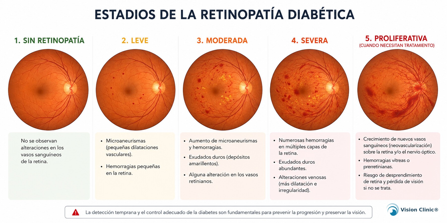 Stages of diabetic retinopathy, from no retinopathy to proliferative