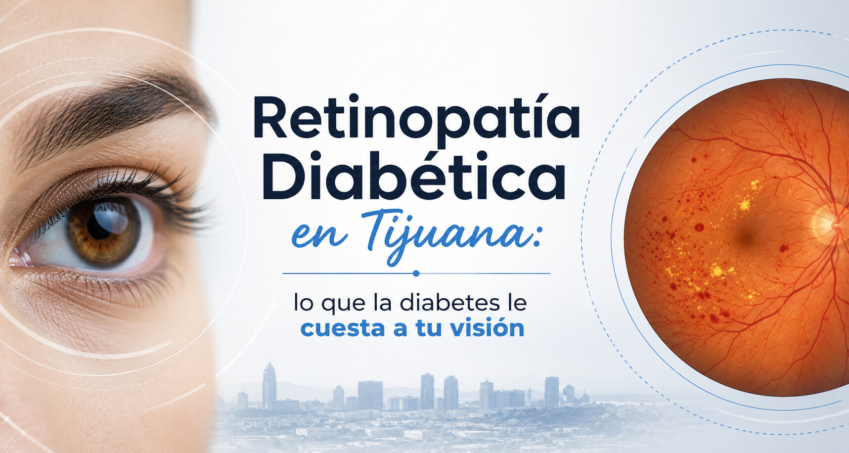 Retinopatía Diabética en Tijuana: lo que la diabetes le cuesta a tu visión