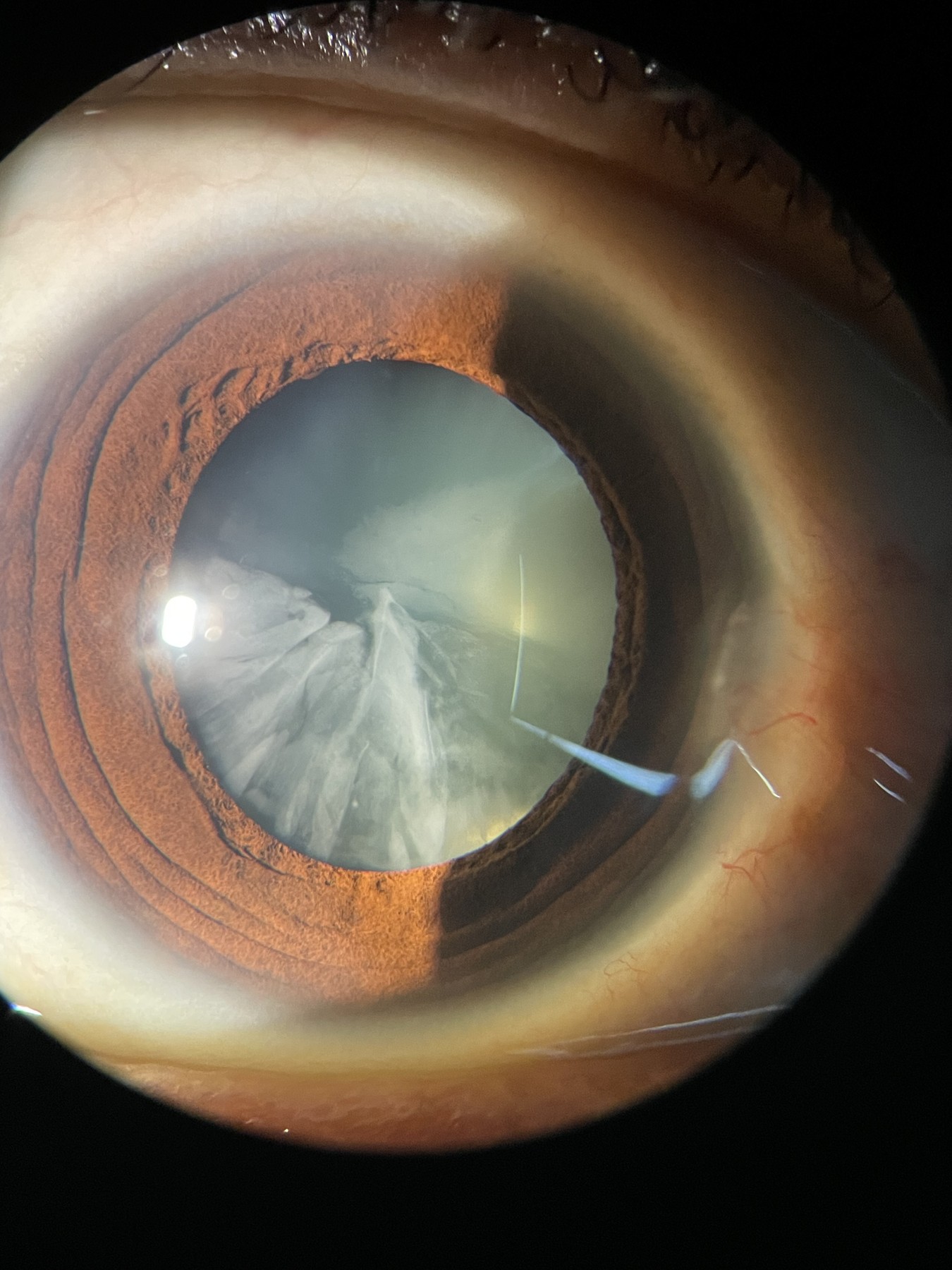 Catarata cortical