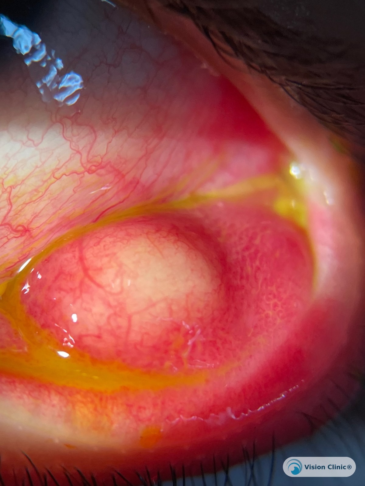 Vision Clinic® patient photo.