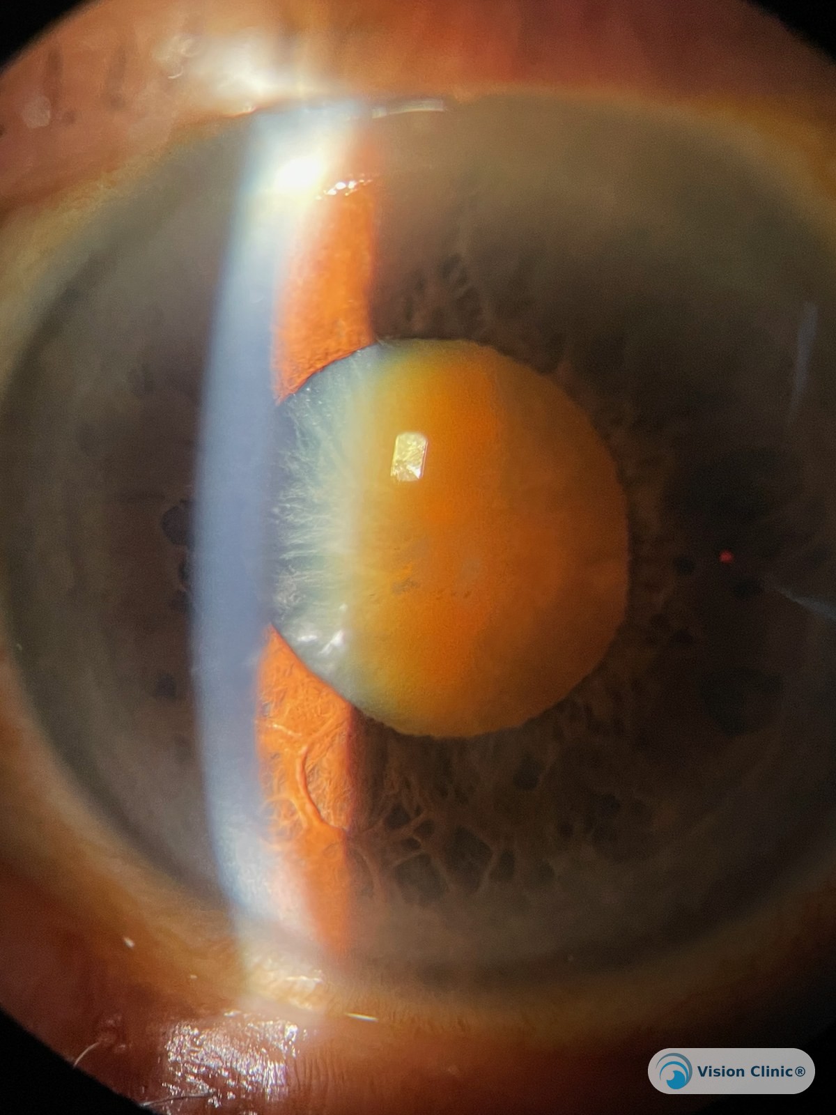 Catarata nuclear avanzada en un paciente de la tercera edad, con opacificación muy densa del núcleo. Paciente de Vision Clinic®.