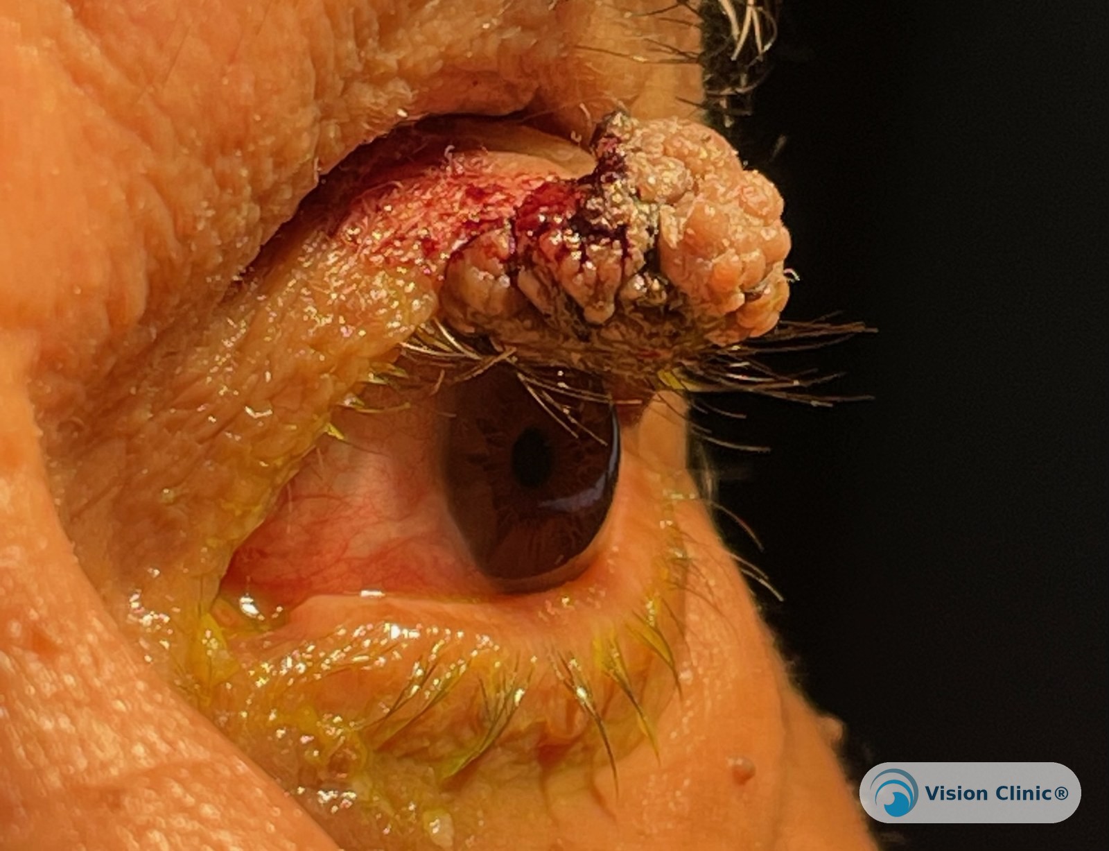 Foto de paciente de Vision Clinic®.