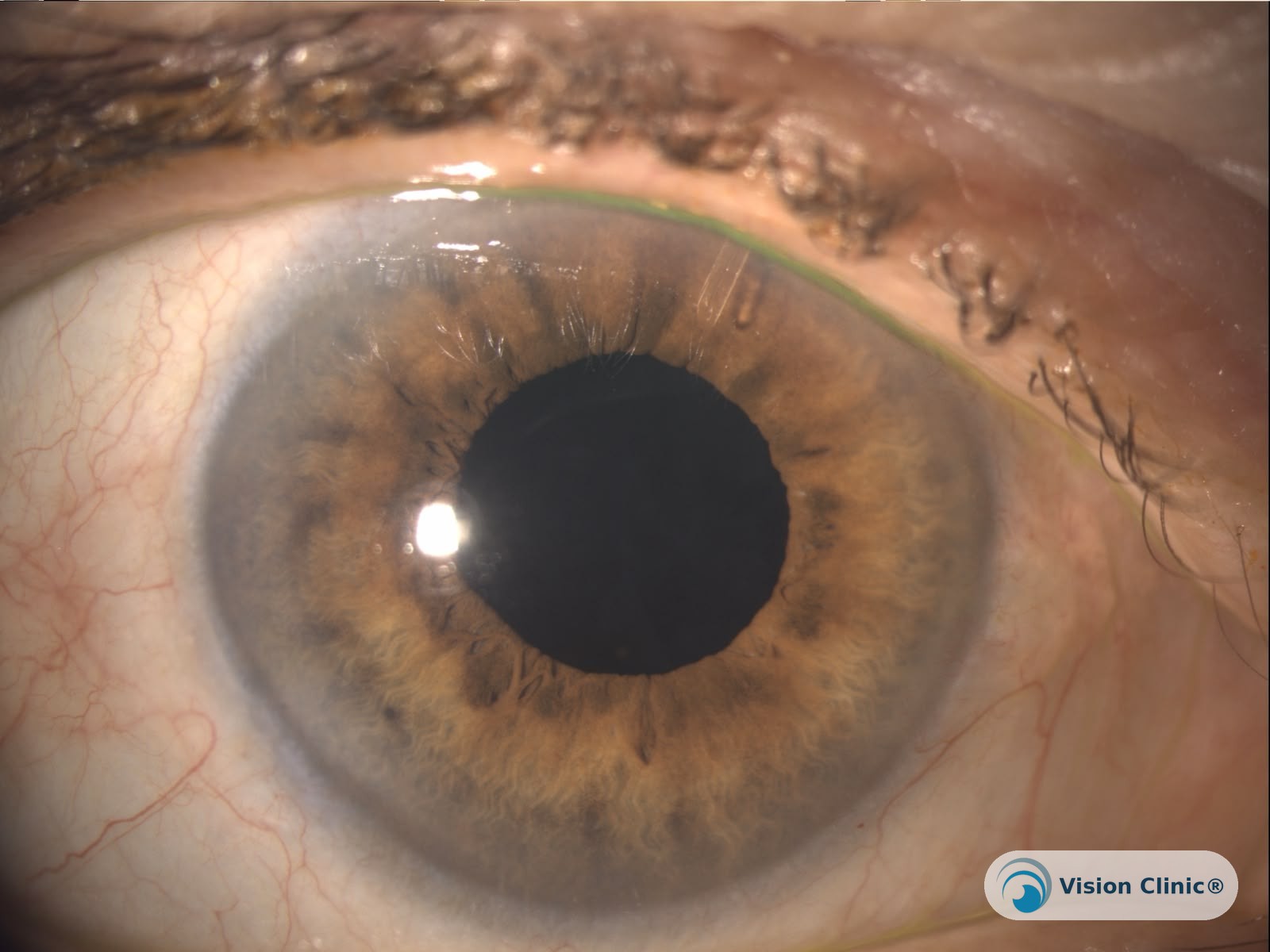 Paciente real de Vision Clinic® tras cirugía de catarata con implante PreserFlo para control de catarata y glaucoma, realizada por el Dr. Ricardo Mata.