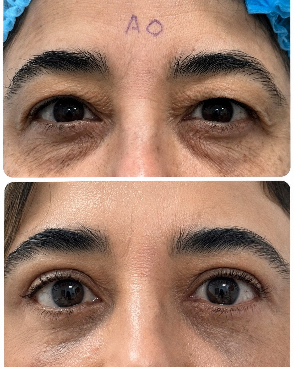 Before and after blepharoplasty
