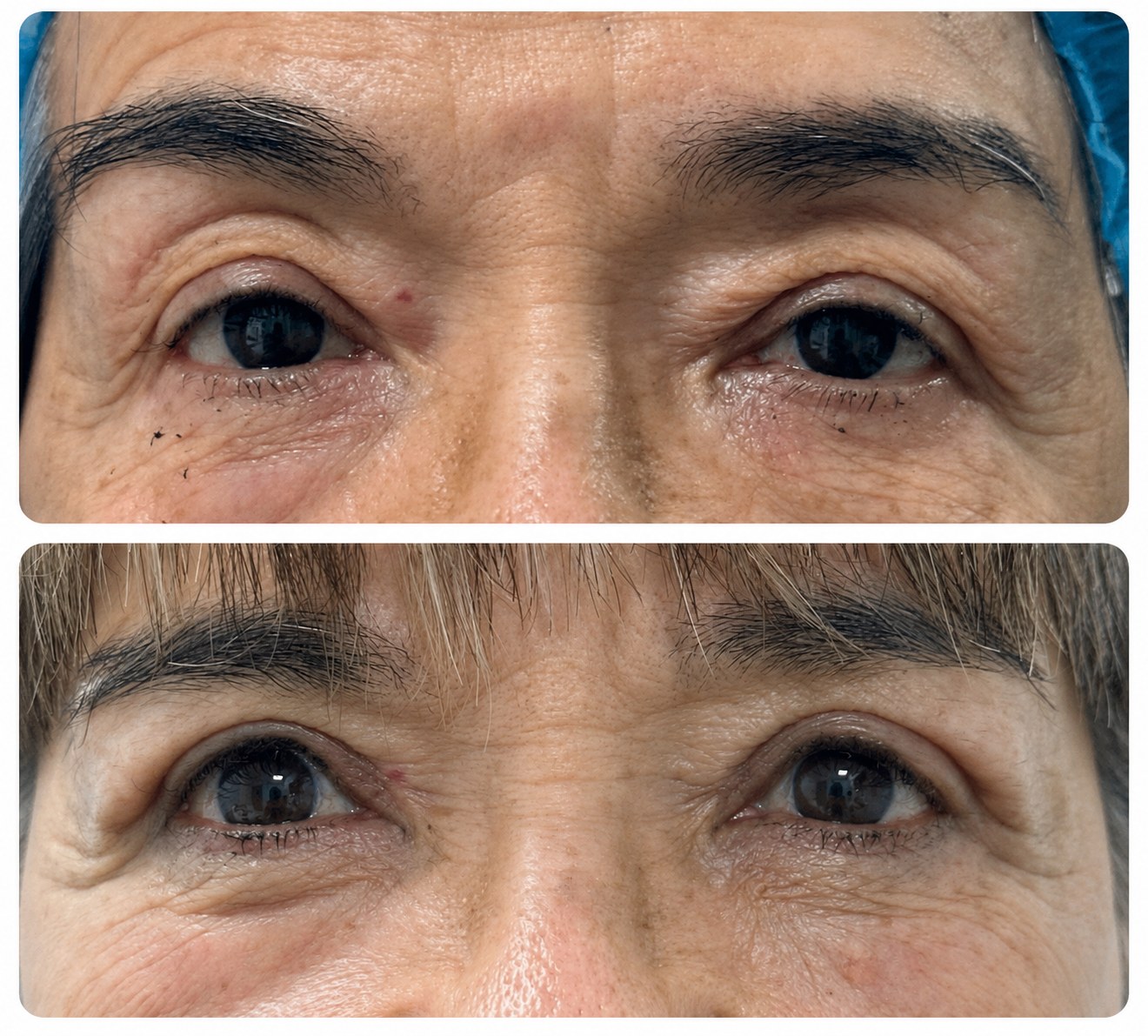 Before and after blepharoplasty